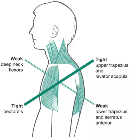 상지교차 증후군으로 앞쪽은 타이트하고 뒤쪽은 안정성이 떨어져 있다.